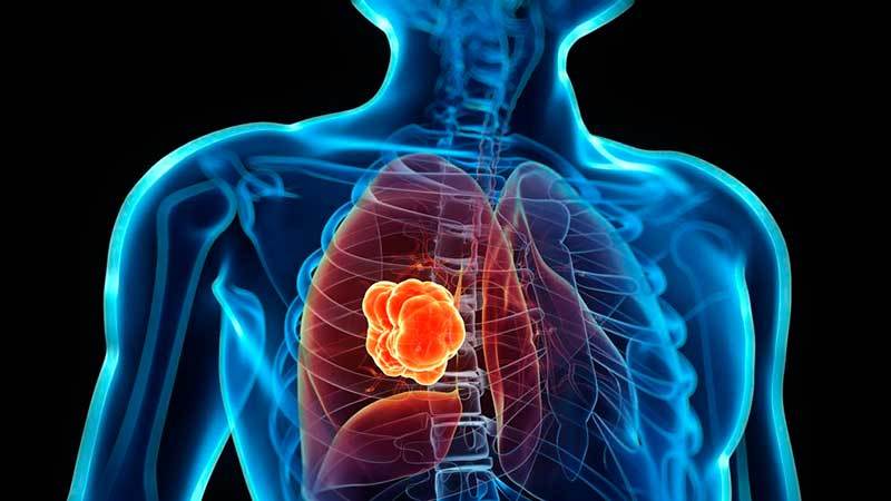  Cáncer de pulmón: la importancia del diagnóstico precoz ante uno de los tumores más frecuentes