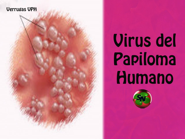  ¿Cómo saber si usted padece VPH (virus de papiloma humano)?