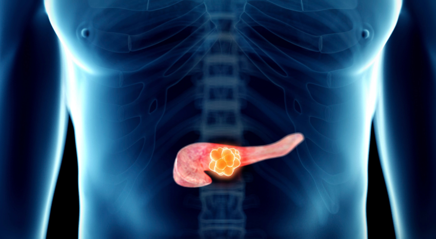  Inteligencia artificial china ayuda a detectar el cáncer de páncreas en una fase temprana