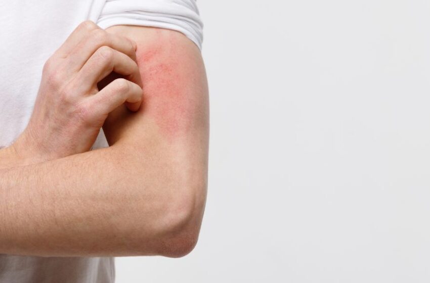  Destacan impacto social y emocional de la dermatitis atópica 