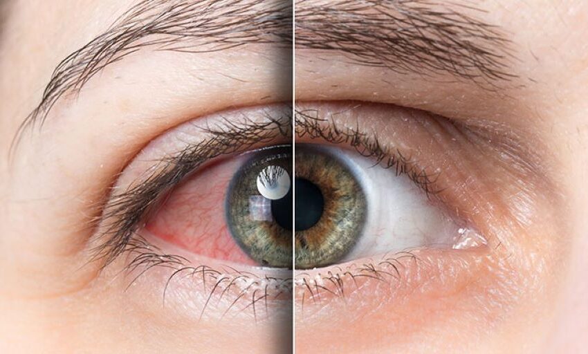  La microbiota ocular, un factor clave en el ojo seco