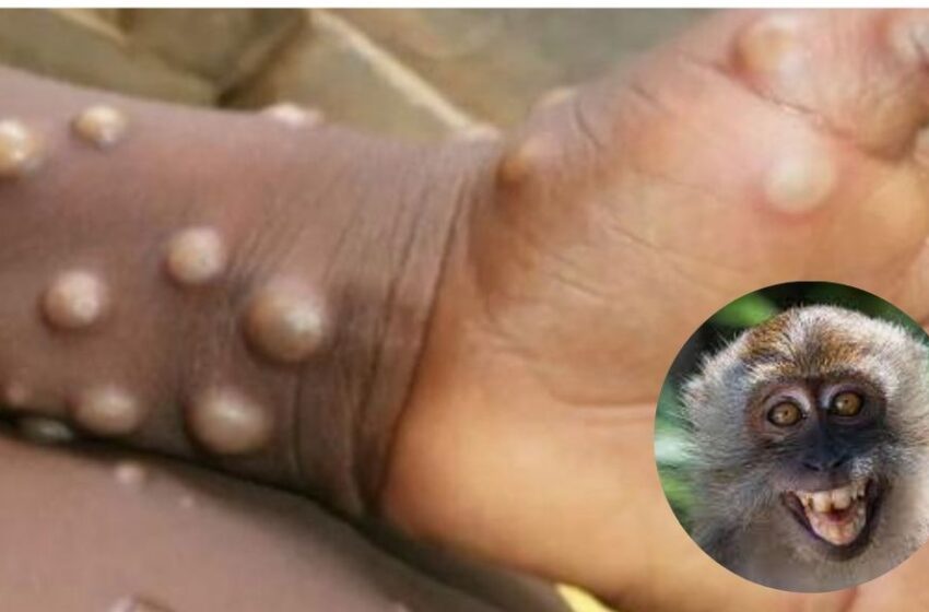  Dermatóloga pide calma y precaución ante alerta por viruela del mono en el país
