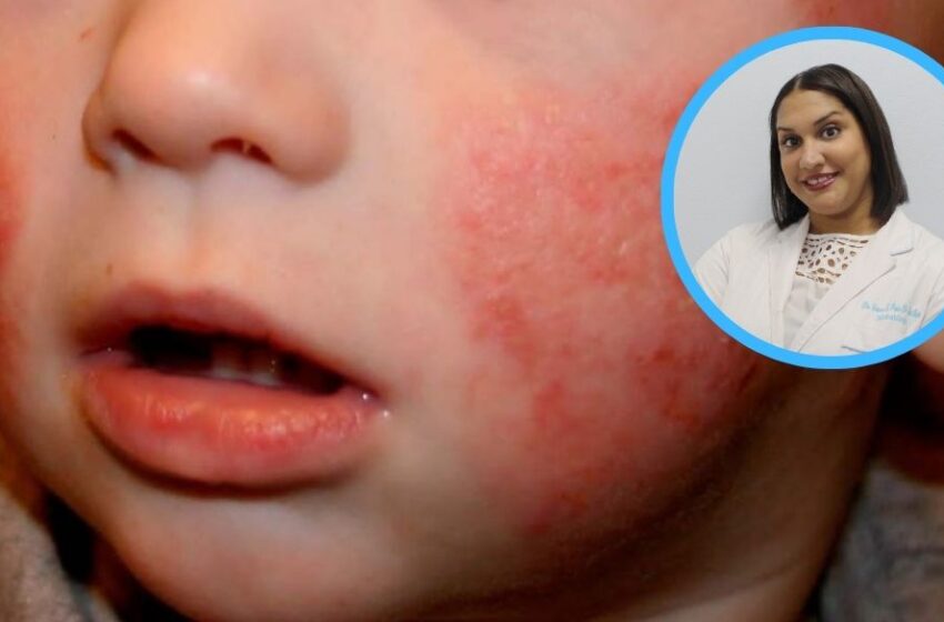  85 % de casos de dermatitis atópica se manifiesta antes de los cinco años
