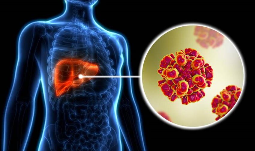  Hepatitis B y C tienen mayor potencial de convertirse en enfermedades crónicas