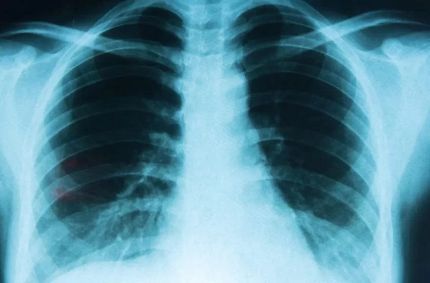  Cáncer de pulmón muestra sus garras en RD y 52% casos se detecta tarde