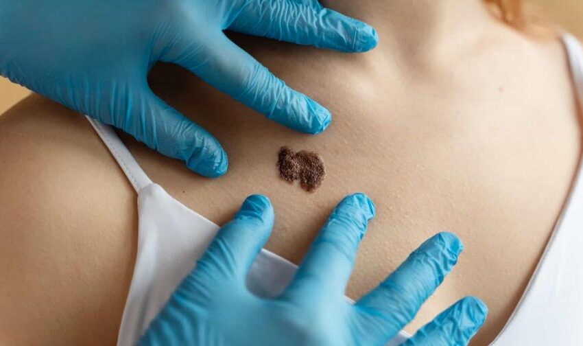  El cáncer de piel avanza en silencio en República Dominicana, alerta el Instituto Dermatológico