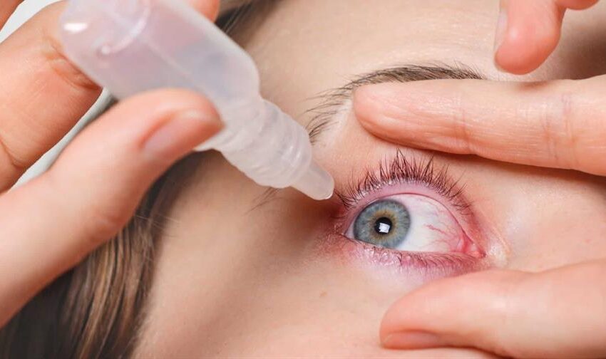  Conjuntivitis, una manifestación que puede estar asociada a la circulación de virus respiratorios