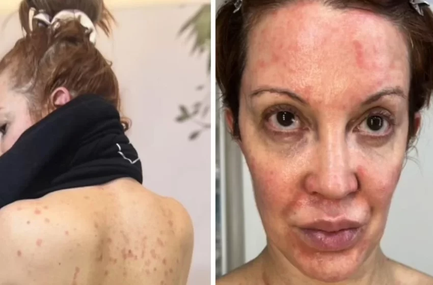  Qué es y cómo se trata la psoriasis, la enfermedad que tiene Miriam Lanzoni