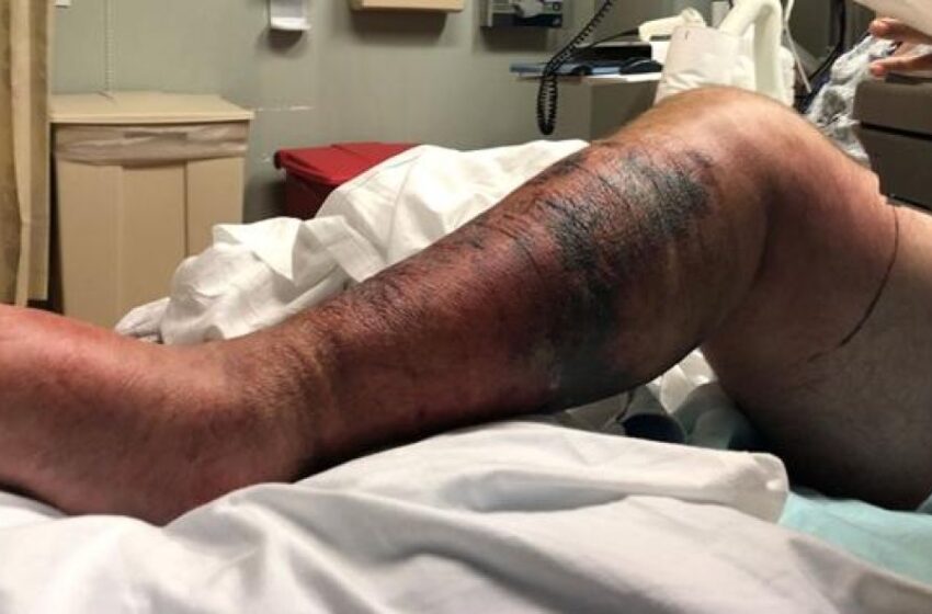  Encuentran bacteria carnívora en aguas Long Island pueden matar personas en 48 horas