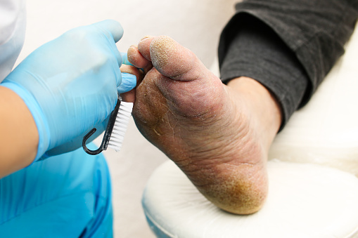  Amputaciones por pie diabético, una de las consecuencias graves de la enfermedad