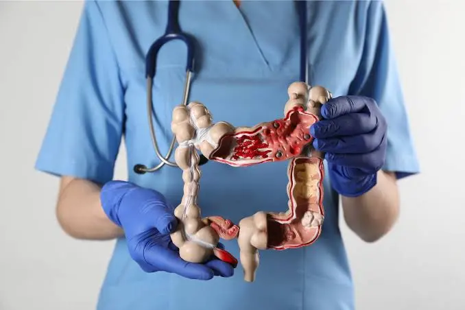  Qué es la enfermedad de Crohn y por qué pacientes protestan por falta de medicamentos