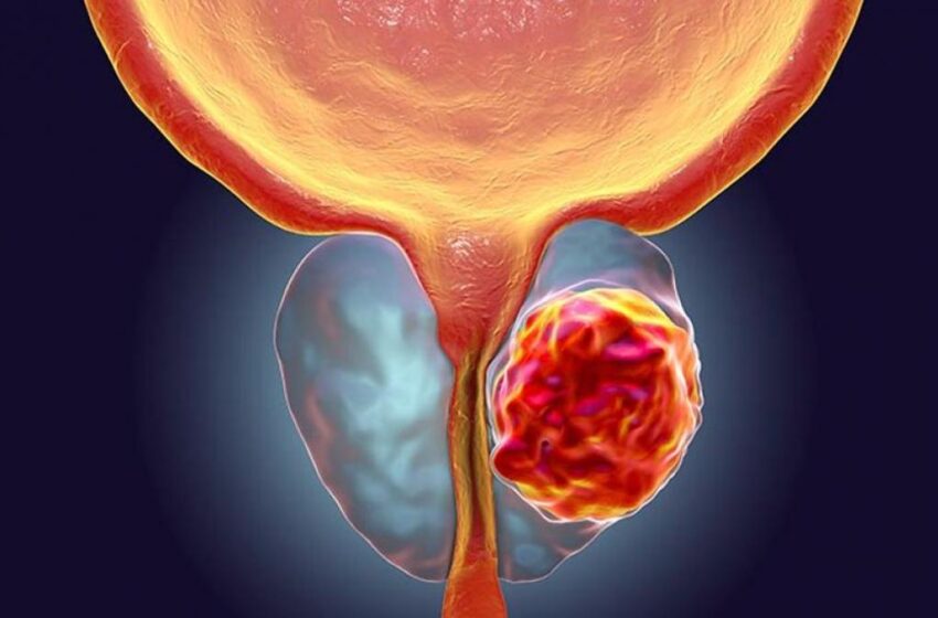  Cinco datos clave que los hombres con cáncer de próstata desearían haber sabido antes de su diagnóstico