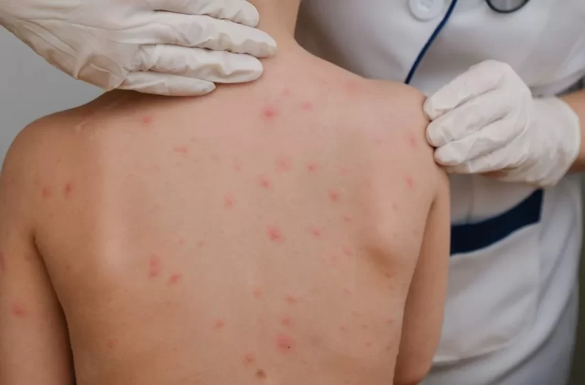  Viruela símica: ¿cómo prevenir el contagio y cuáles medidas tomar?