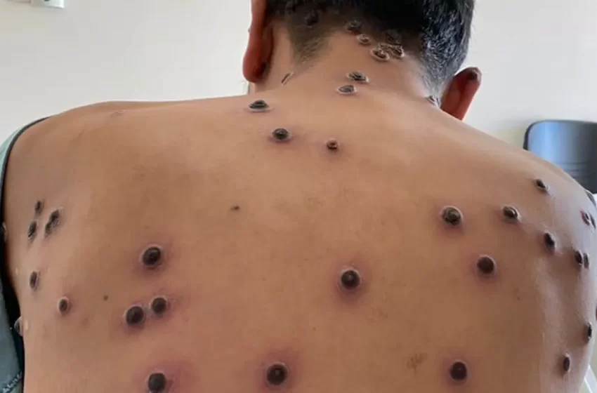  Viruela símica: qué es, cómo se transmite, síntomas y cómo prevenirla