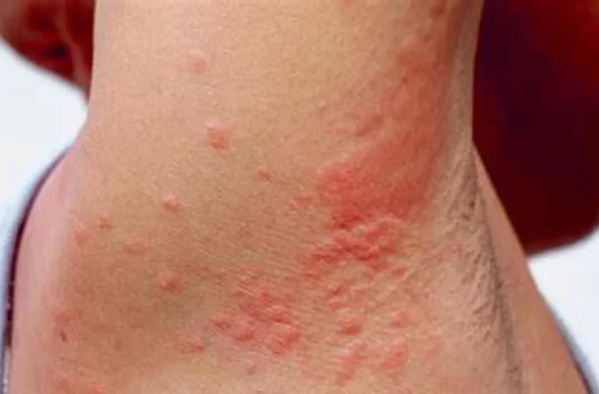  Dermatitis atópica: por qué la piel puede picar tanto y qué la desencadena