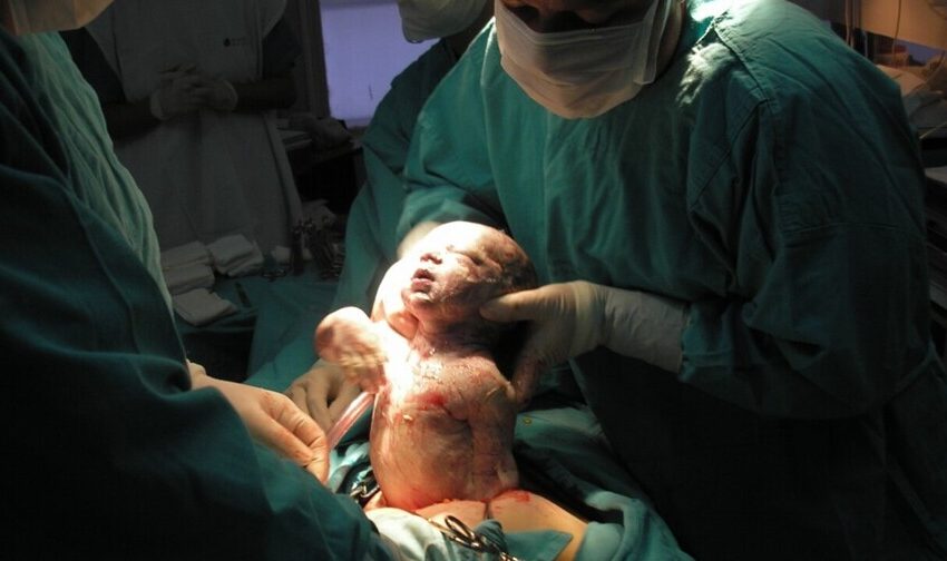  Sociedad de Obstetricia sobre la alta tasa de cesáreas en RD: «Ha rebasado el límite»