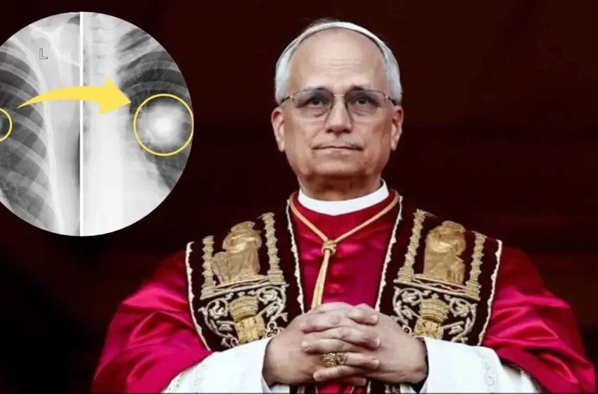  ¿Qué es un nódulo pulmonar, diagnóstico del papa León XIV?